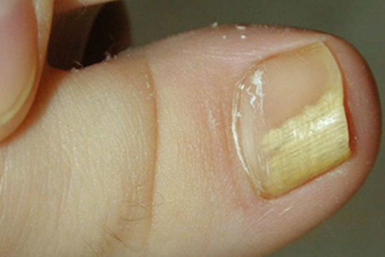 银屑病甲增厚图 银屑病甲增厚图