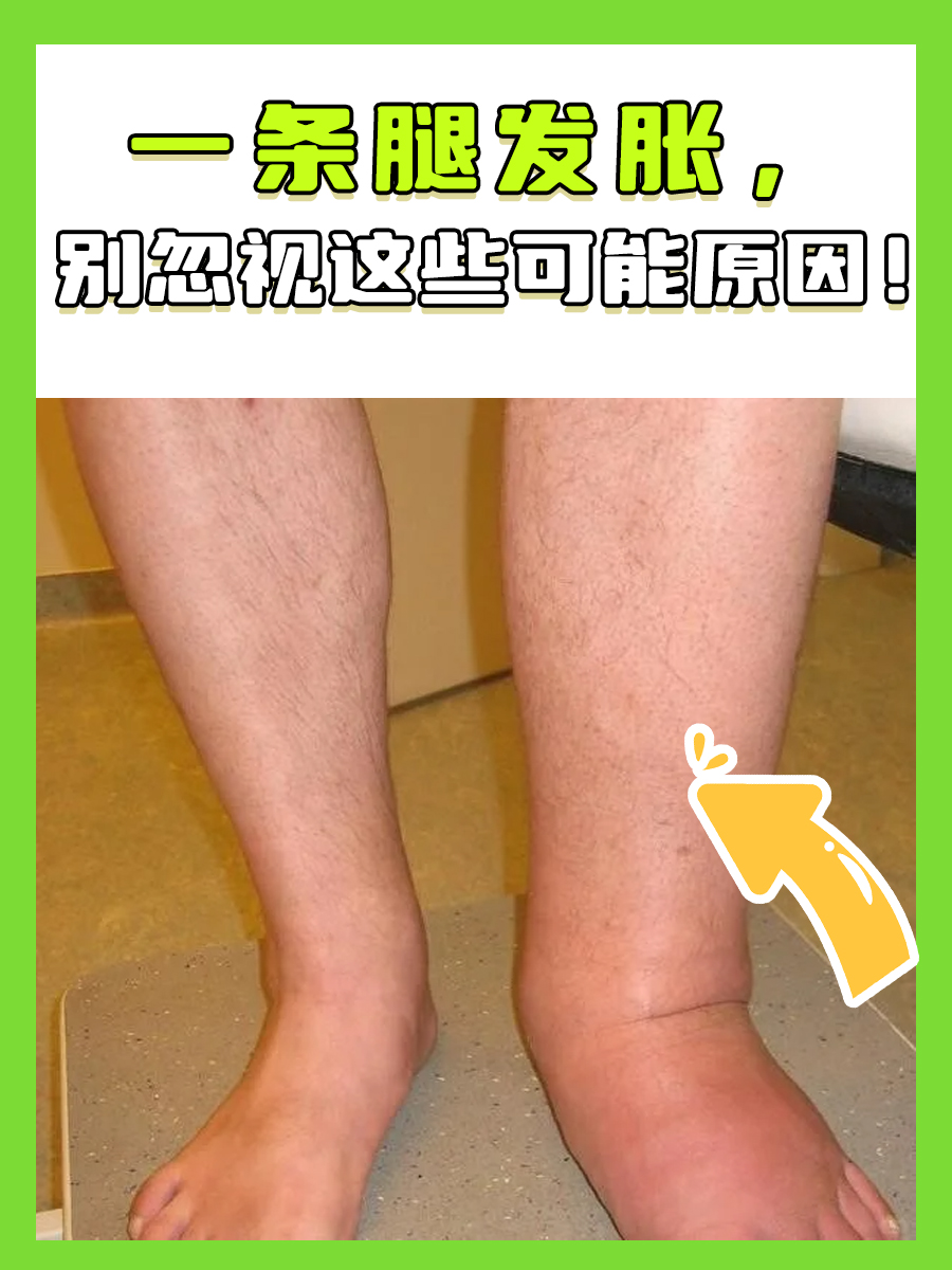 一条腿发胀，别忽视这些可能原因！