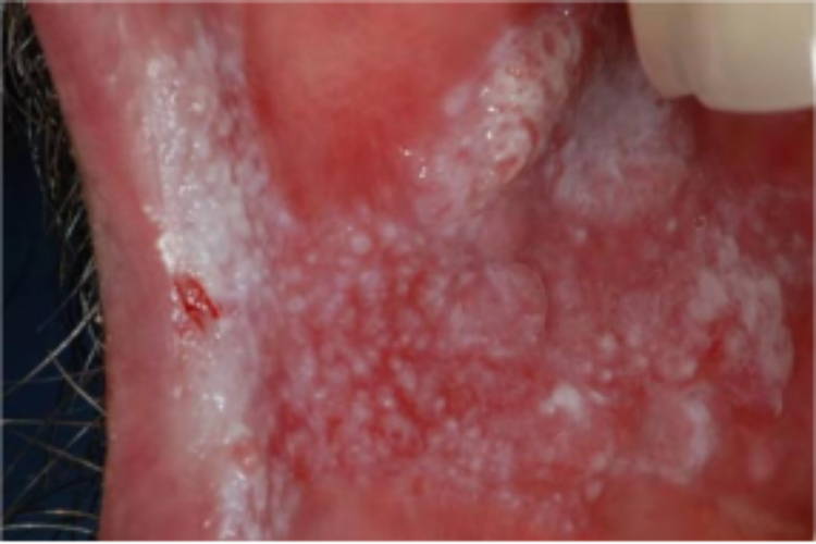 慢性增殖型念珠菌病图