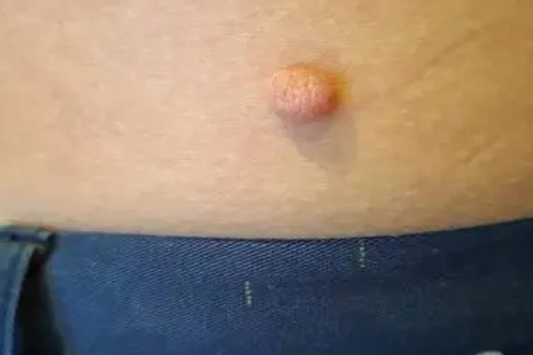 腰部长寻常疣图