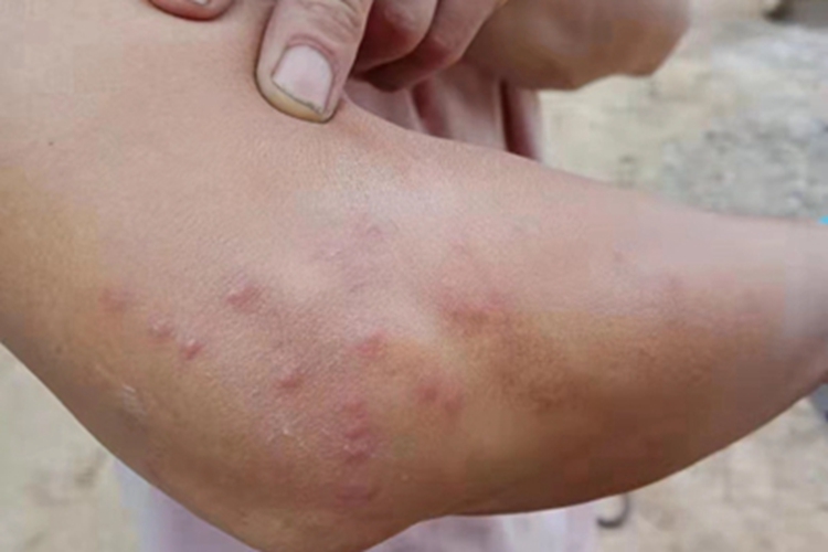 过敏性皮炎肘部小红疙瘩图 过敏性皮炎肘部小红疙瘩图