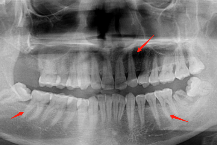 牙根影像学图片 牙根影像学图片