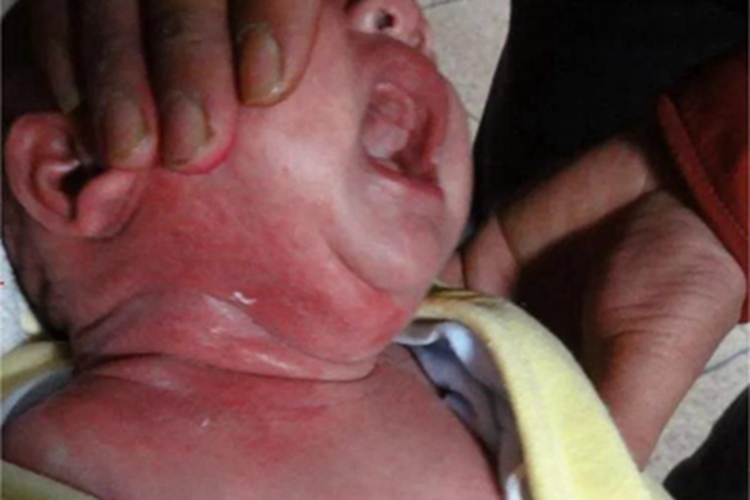 念珠菌性间擦疹侧颈红斑图