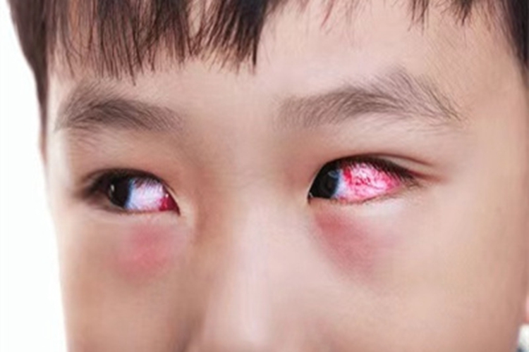 川崎病眼球充血图