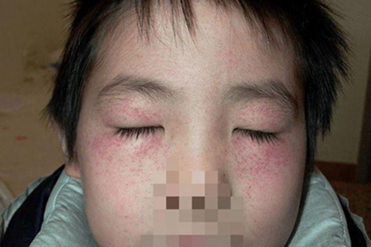 机械性紫癜面部红点图