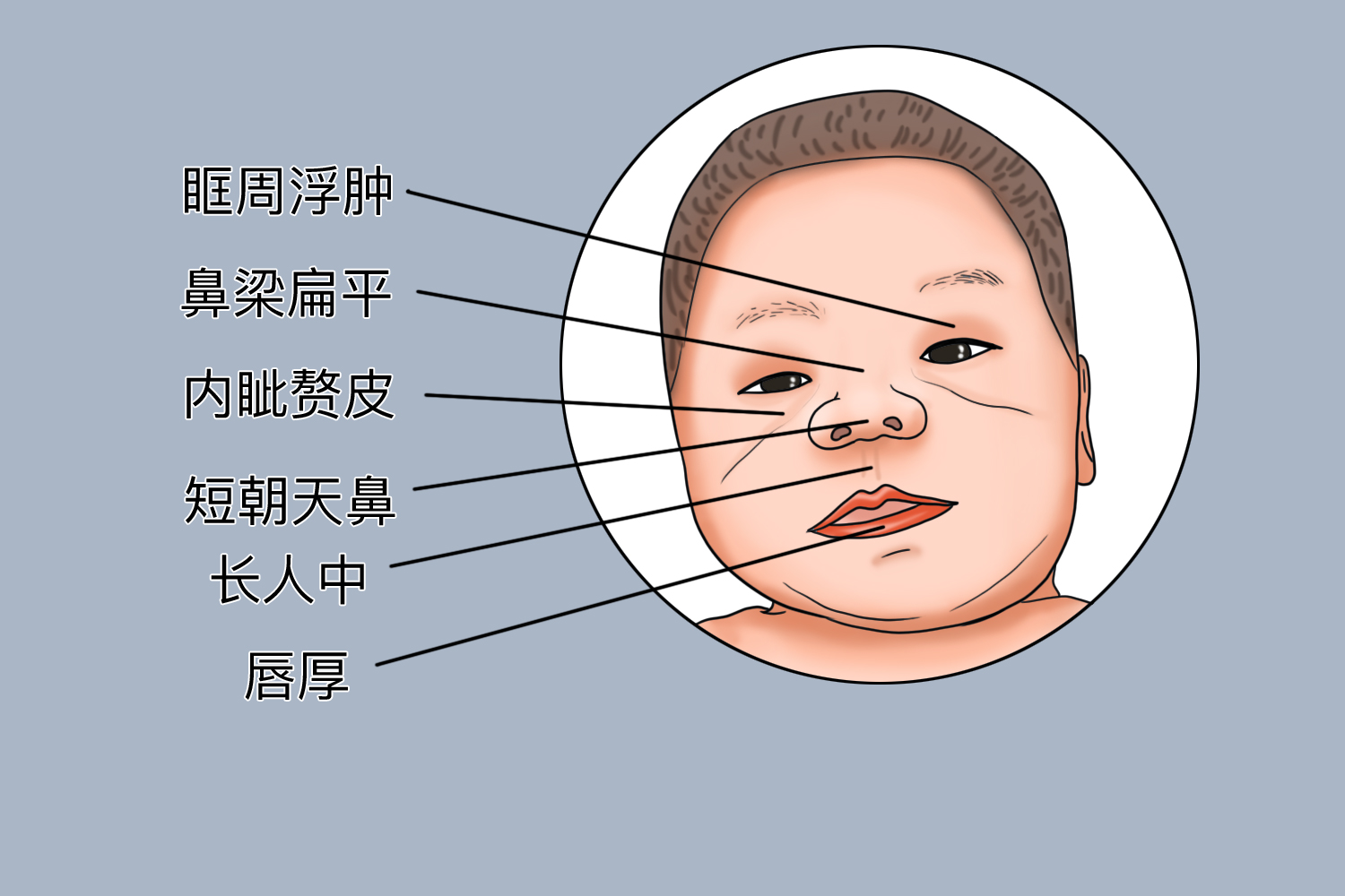 Williams综合征宝宝图