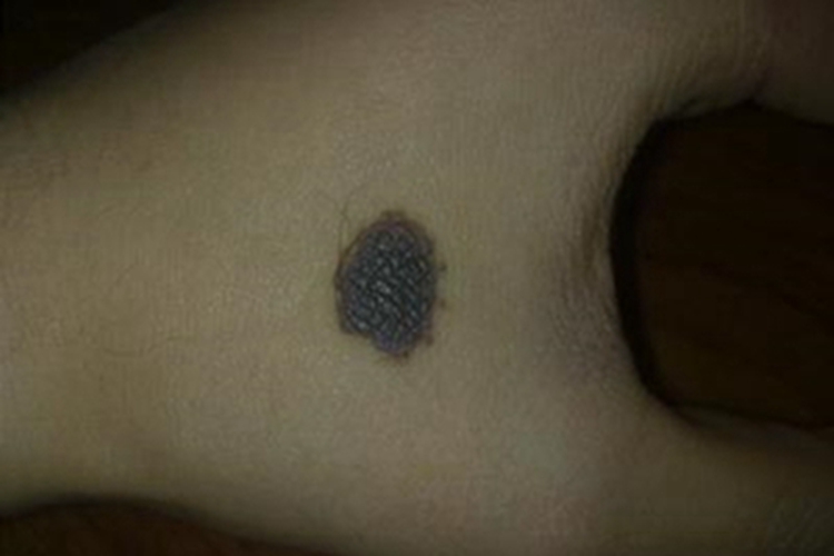 复合痣手背症状图