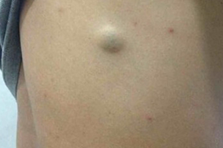 皮脂腺囊肿背部大包图