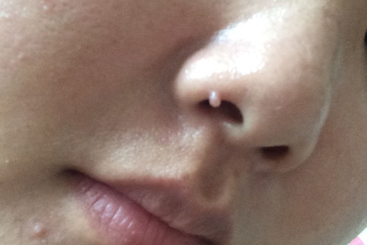 寻常疣图 寻常疣图