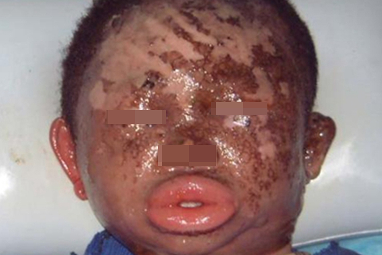 深Ⅱ度烧伤肿图