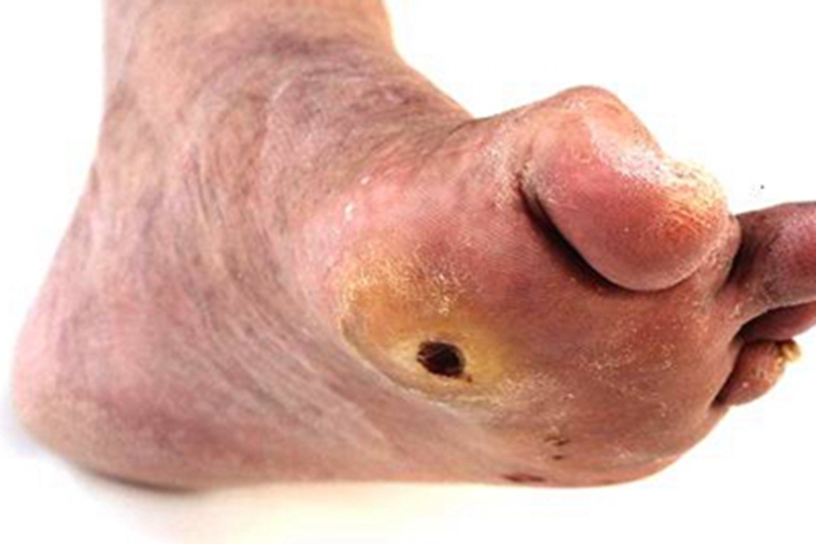 干性坏疽脚底皮肤发黑图