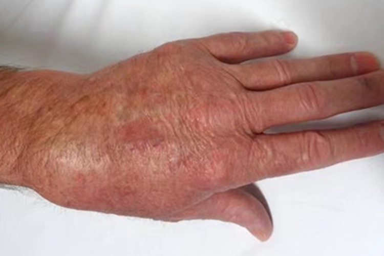 肩手综合征疼痛期水肿减轻图