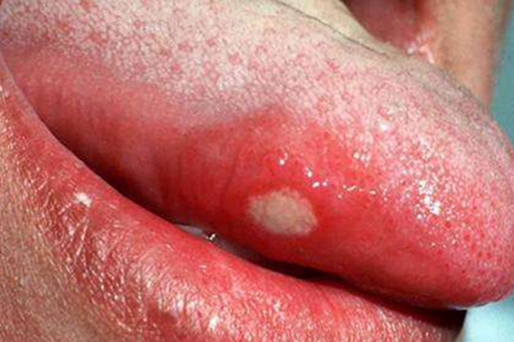 舌癌舌头溃烂形成白斑图