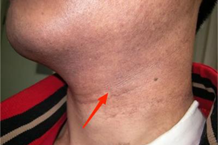 皮肤黑变病颈部皮肤颜色加深图