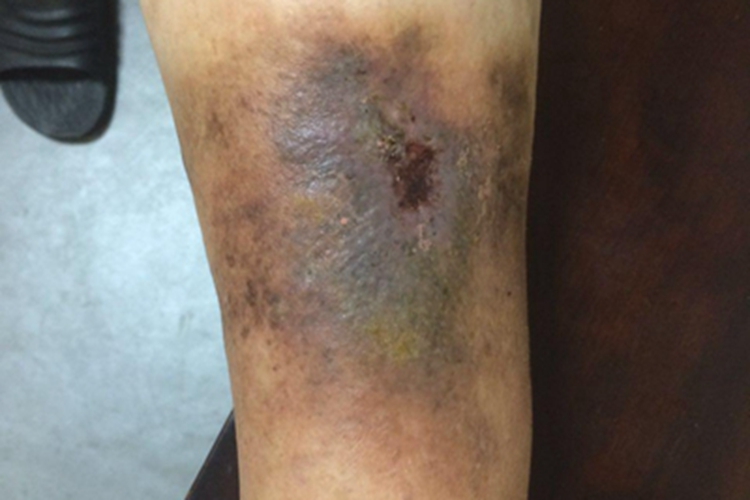 淤积性皮炎小腿溃疡图