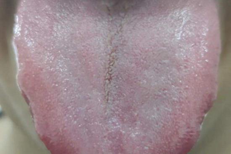 肾阳虚淡红舌图 肾阳虚淡红舌图