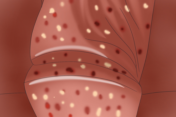念珠菌性包皮龟头炎图 念珠菌性包皮龟头炎图