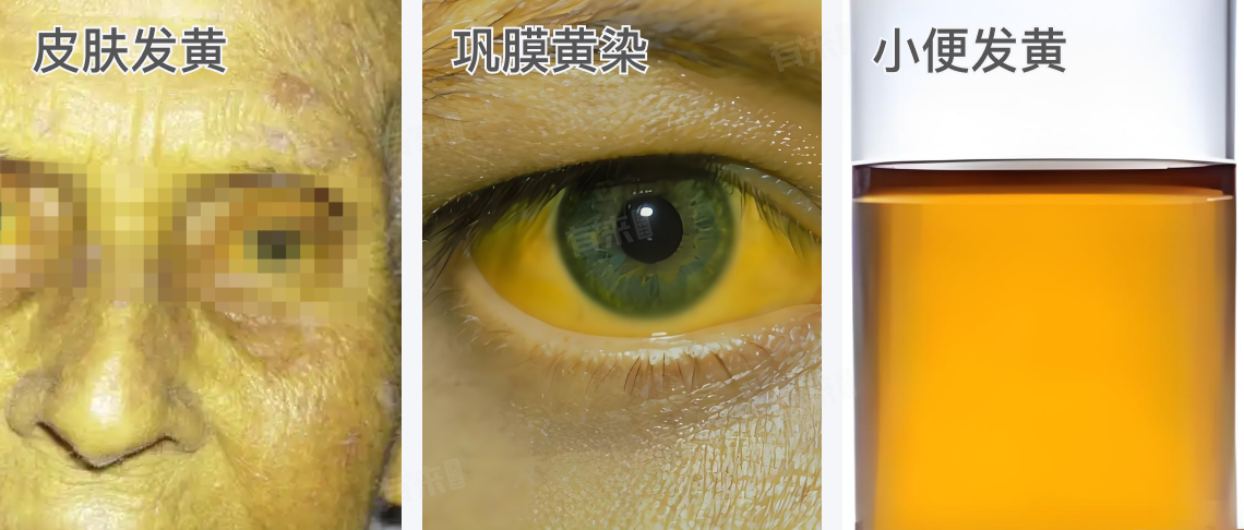黄疸是什么样子的图片-有来医生