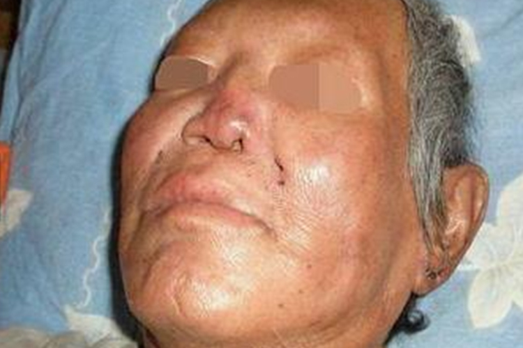 麻风病鼻塌陷图