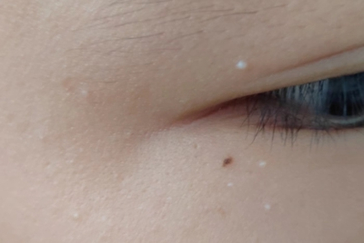 原发性粟丘疹眼角有白色小疙瘩图