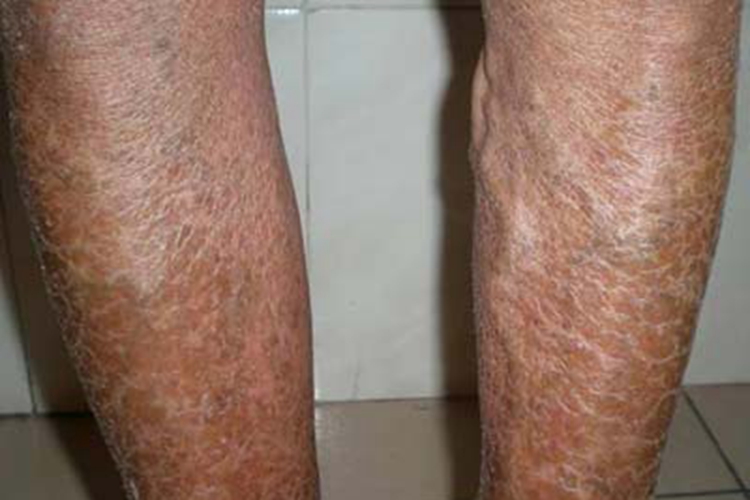 老年性皮肤萎缩小腿症状图