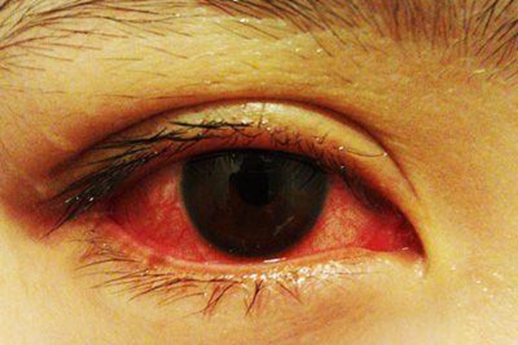 流行性出血性结膜炎血丝图 流行性出血性结膜炎血丝图