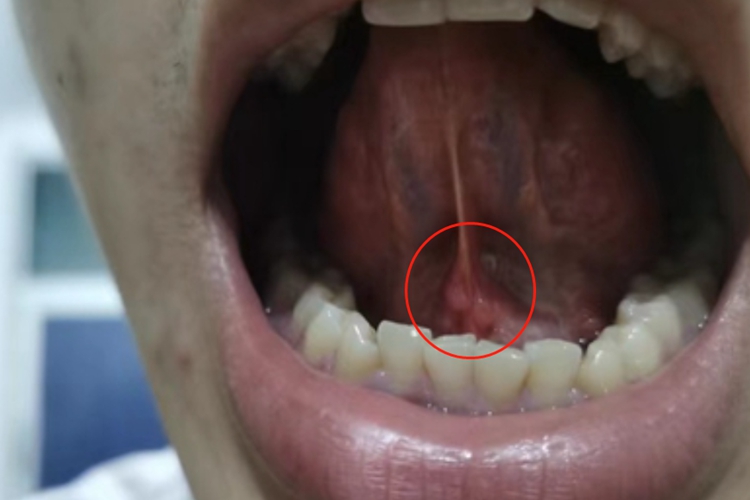 唾液腺结石病舌头症状图 唾液腺结石病舌头症状图