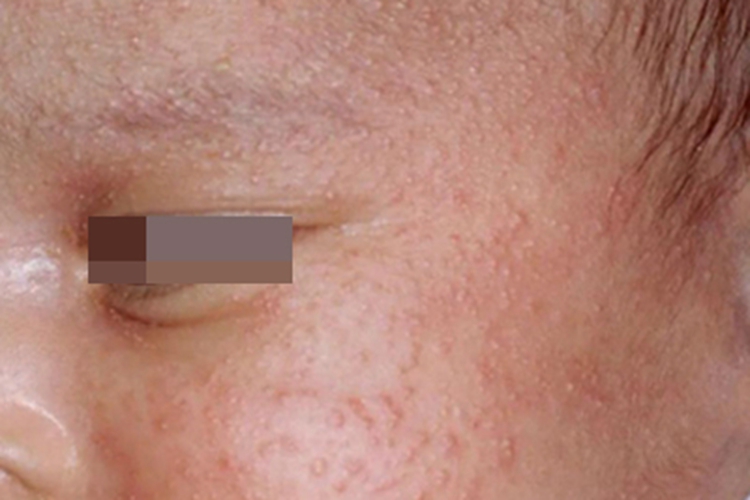 新生儿痤疮面部很多小疹子图