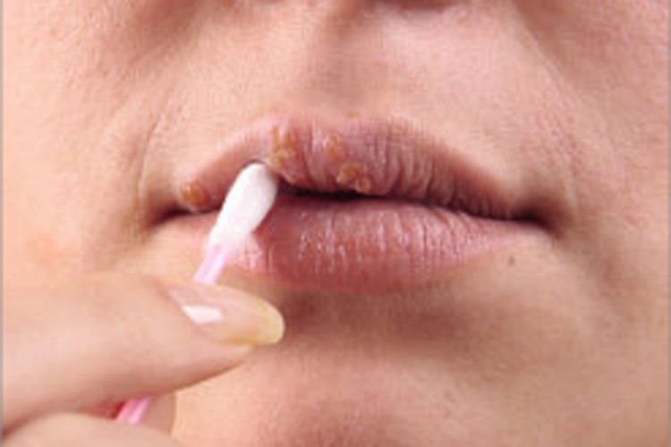 慢性唇炎嘴唇有黄痂图