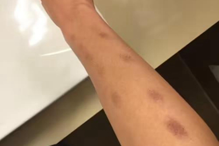 炎症后色素沉着胳膊症状图