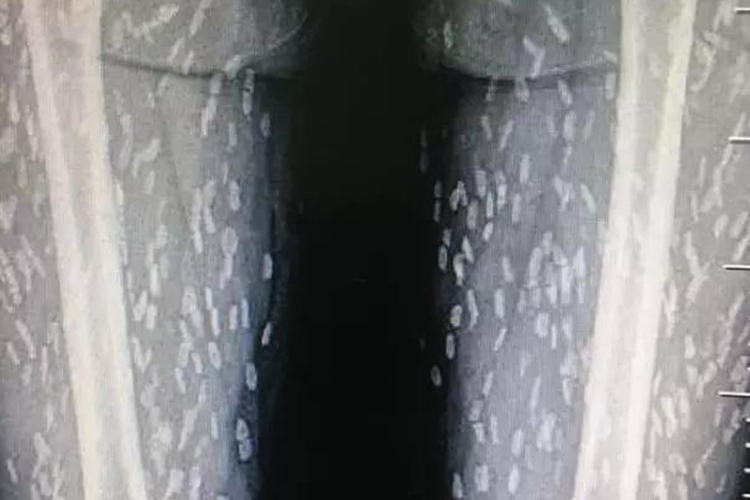 囊虫病下肢影像图