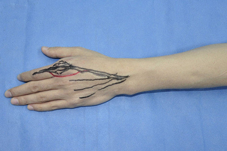 手指肌腱松解术麻醉范围图 手指肌腱松解术麻醉范围图