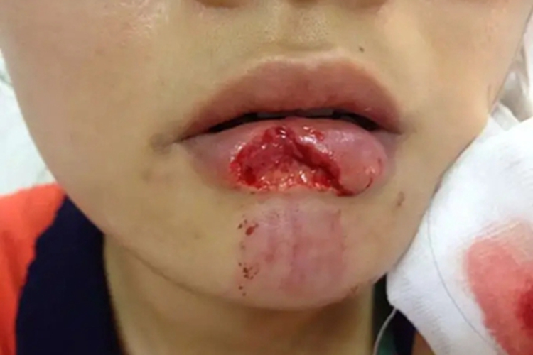 唇缺损下嘴唇缺了一块图