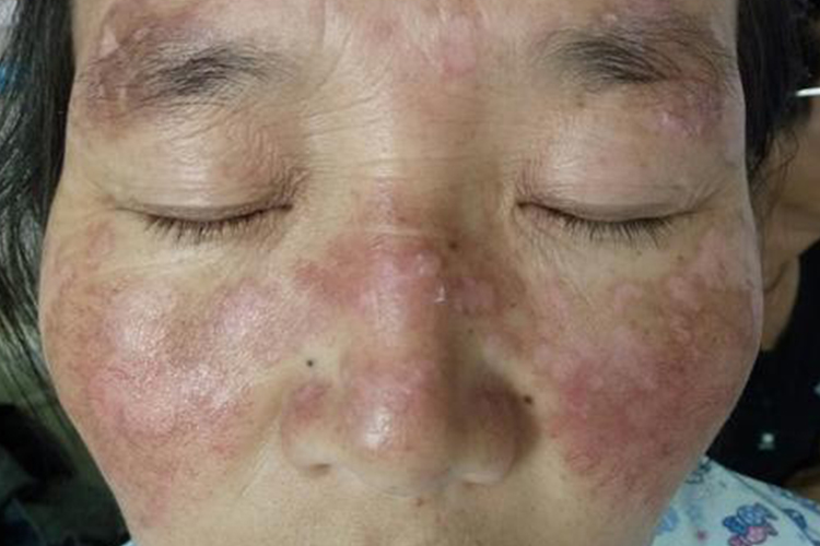 面部蝶形红斑狼疮图