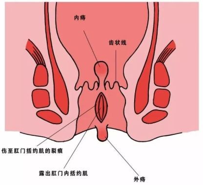 女性痔疮早期的症状