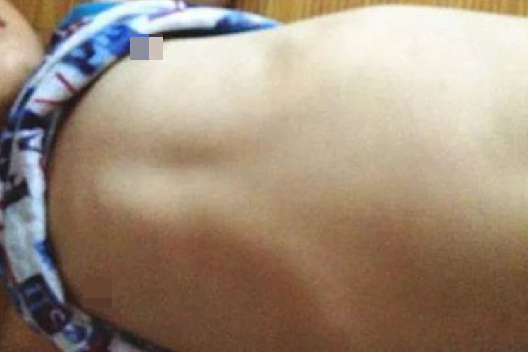 鸡胸前胸一侧骨头突出图