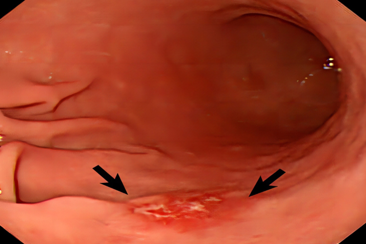 慢性胃炎胃镜图