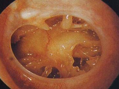 慢性化脓性中耳炎耳朵里长肉芽图.jpg