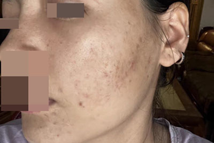 痤疮左半边脸有黑色斑图