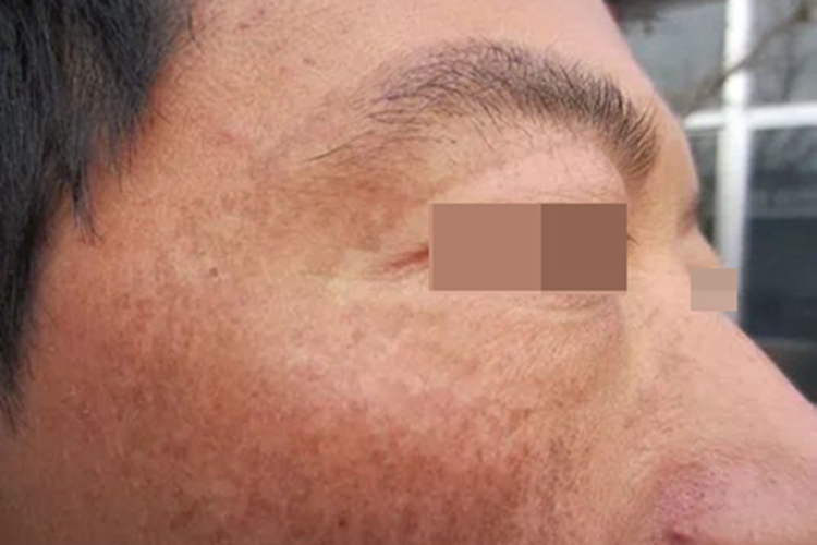 炎症后色素沉着颧部有淡褐斑图