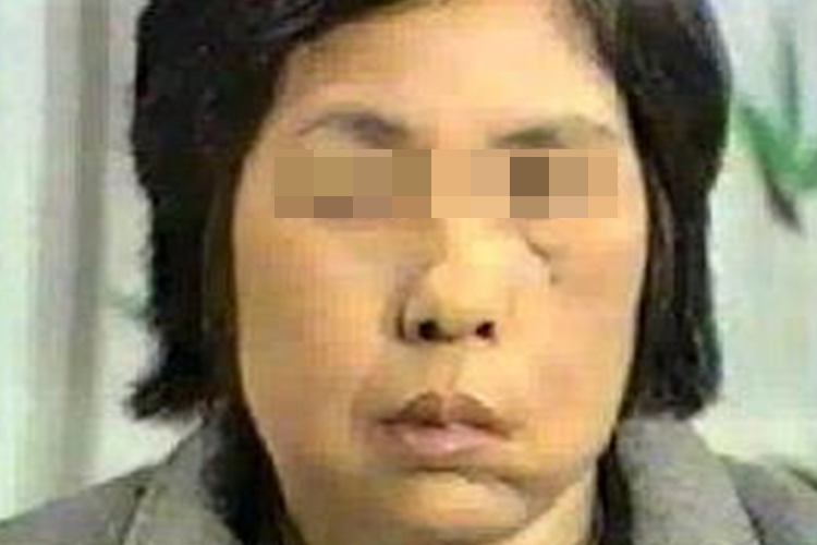 周围性面神经麻痹图