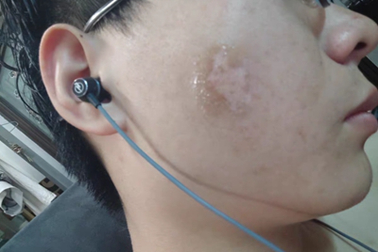 稳定期节段型白癜风白斑图 稳定期节段型白癜风白斑图