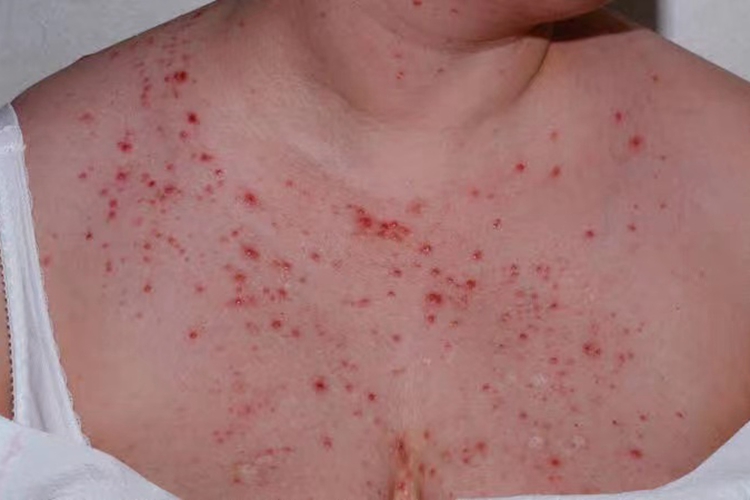 脖子和胸口痤疮图 脖子和胸口痤疮图