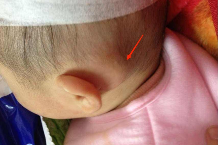 婴幼儿化脓性淋巴结炎耳后症状图