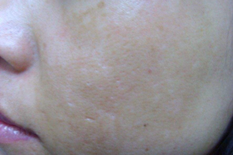 颜面再发性皮炎面部皮肤颜色加深图.jpeg