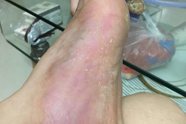 更年期角皮症长斑图片