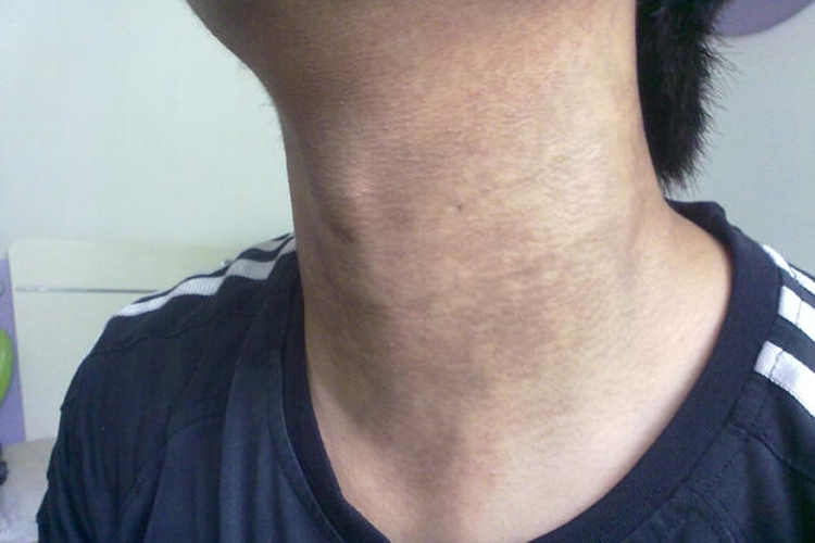 焦油性黑变病颈部皮肤发黑图