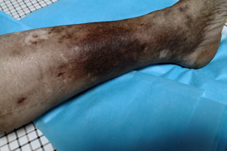 淤积性皮下硬化症小腿皮肤发黑图 淤积性皮下硬化症小腿皮肤发黑图
