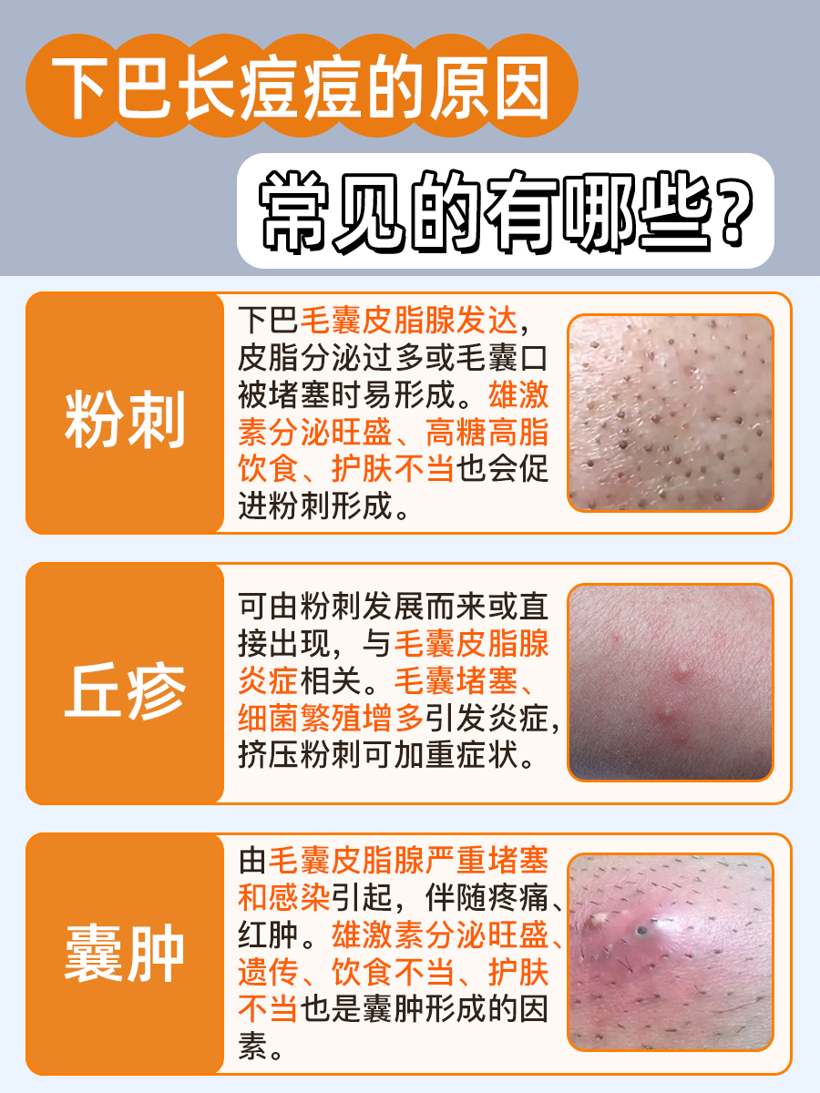 下巴长痘痘,原来是这些原因在作怪!