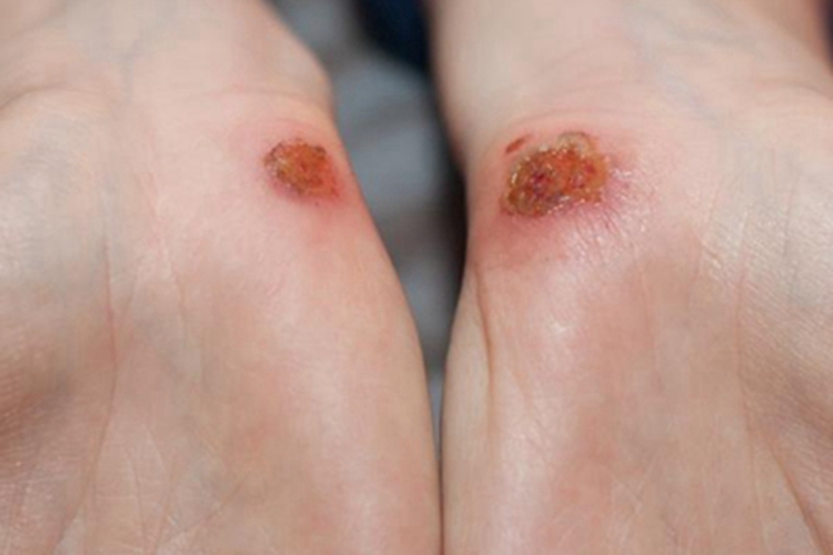 巴尔通体病手部糜烂图